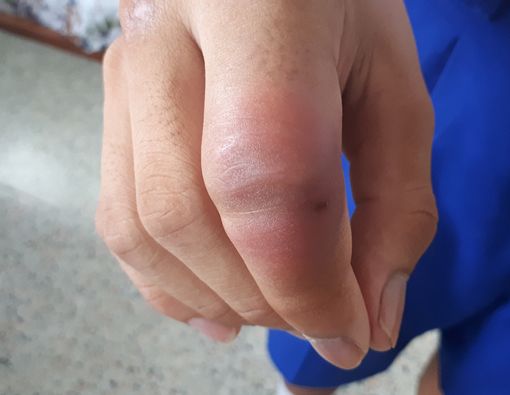 10 Penyebab Jari Bengkak yang Perlu Anda Tahu
