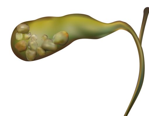 Pola Makan Sehat Usai Operasi Batu Empedu