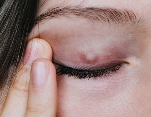 Stres Jadi Penyebab Bintitan, Mitos atau Fakta?