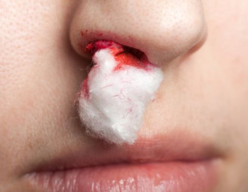 Mimisan Saat Puasa, Lakukan Ini untuk Pertolongan Pertama