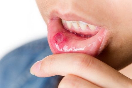 Ini yang Dapat Terjadi Pada Mulut &amp; Gigi Anda Ketika Terkena AIDS