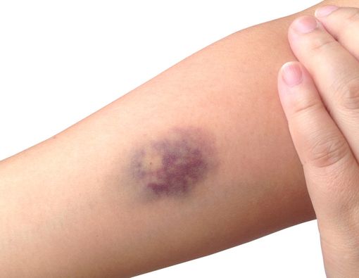 Muncul Memar di Kulit? Waspadai Risiko Penyakitnya