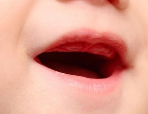 Cara Mengatasi Sariawan pada Anak