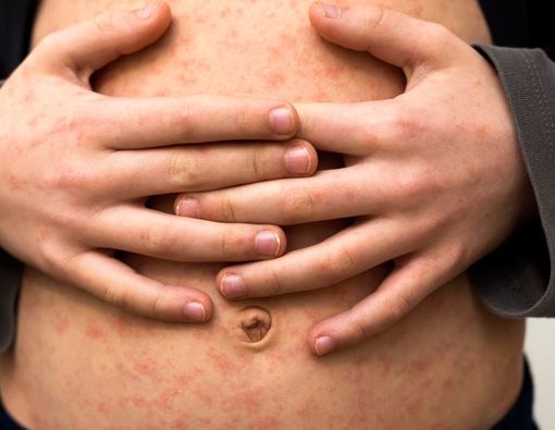 9 Cara Mengobati Penyakit Campak