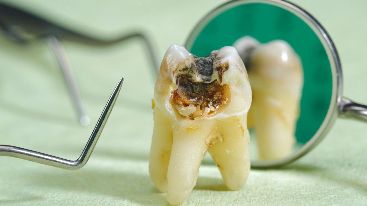 Mengidentifikasi Gigi Mati dan Pilihan Perawatannya