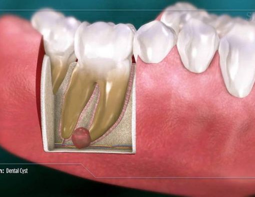 Mengenal Bahaya di Balik Kista Gigi
