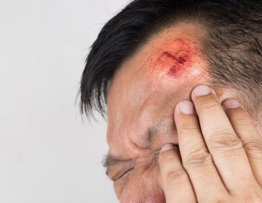 Waspada Jika Anda Nyeri Kepala Setelah Terjedot