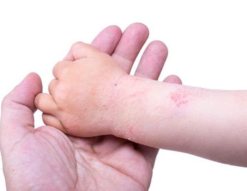 Gejala Eksim yang Anda Harus Tahu