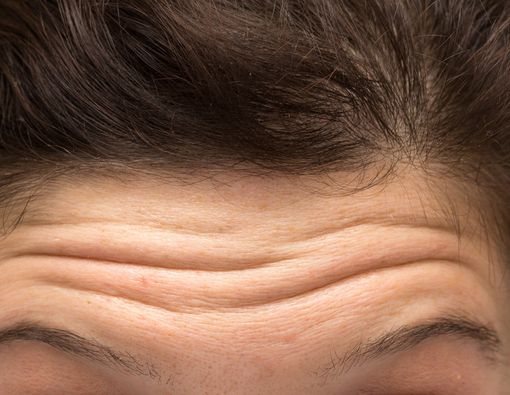 Makna Kesehatan di Balik Keriput di Kening