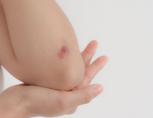 10 Tips Hilangkan Keloid yang Mengganggu Penampilan