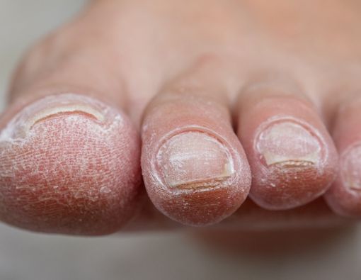 Tips Perawatan Kulit bagi Penderita Diabetes Tipe 2