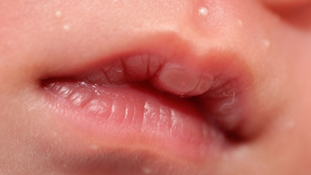 Mengenal Kondisi Lip Blister atau Suck Blister pada Bayi