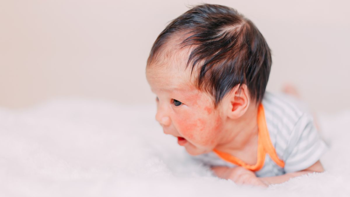 Mama Harus Tahu, Ini 5 Cara Mencegah Eksim dan alergi pada Bayi