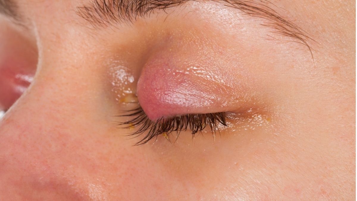 Kenali Gejala Kalazion pada Mata dan Komplikasinya