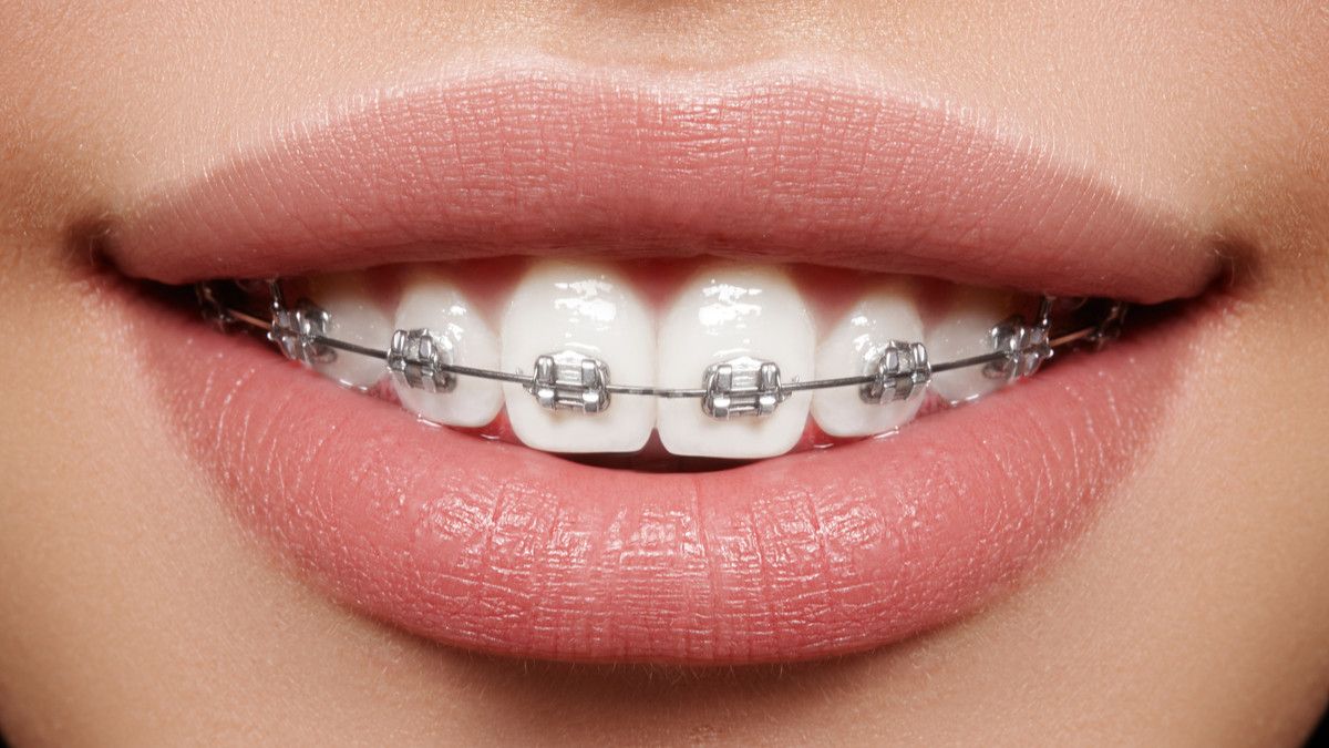 Kawat Gigi Keramik vs Stainless Steel, Mana yang Lebih Baik?