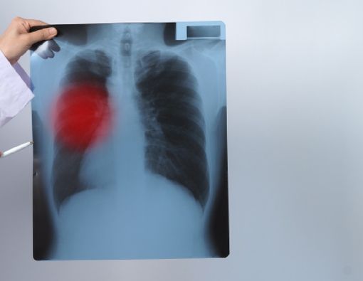 Bagaimana Kanker Paru Dapat Menyebar ke Otak?