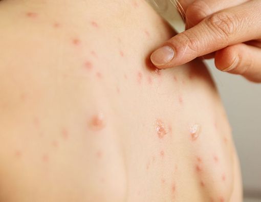 Penyebab Cacar Air dan Faktor Risiko yang Perlu Diwaspadai