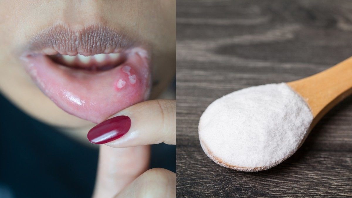 Amankah Menggunakan Baking Soda untuk Sariawan? KlikDokter