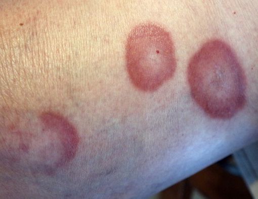 Mengenal Jenis-jenis Granuloma pada Bagian Tubuh