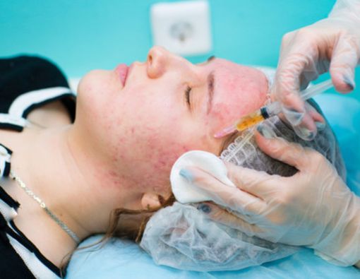 Facial Vampir Bikin Awet Muda?