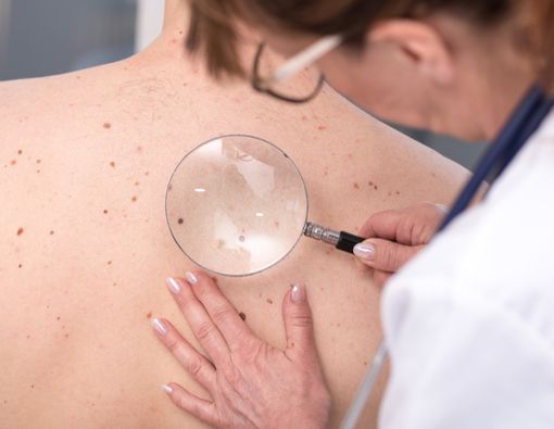 Benarkah Vitamin A Bisa Menurunkan Risiko Kanker Kulit?