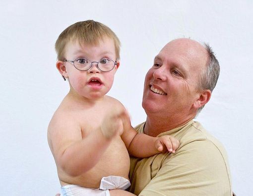 Alergi pada Anak dengan Sindrom Down