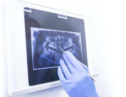 Mengenal Penyebab Spikula Tulang Gigi dan Cara Mengatasinya