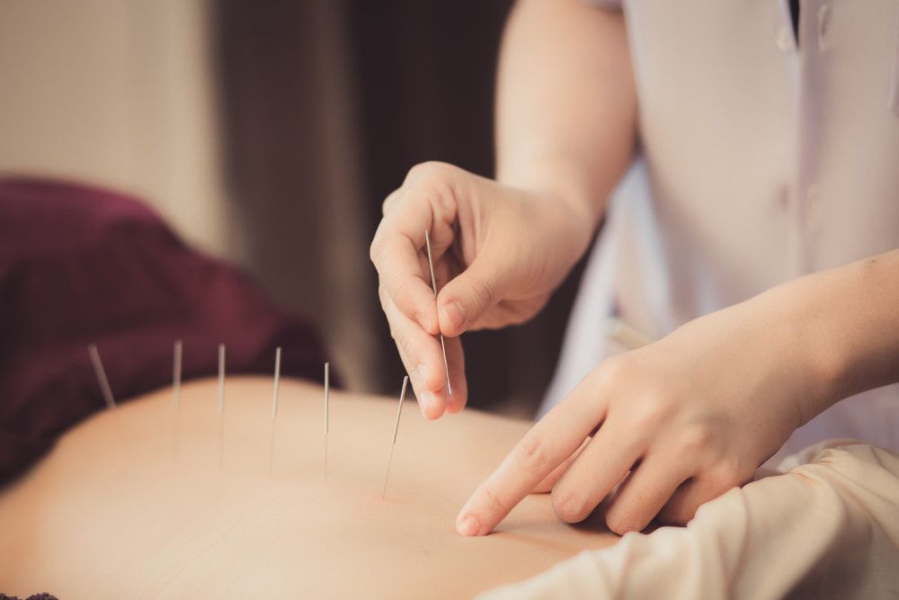 Efektifkah Akupunktur untuk Mengatasi Obesitas?
