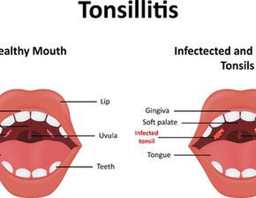 Apa Itu Tonsilitis?