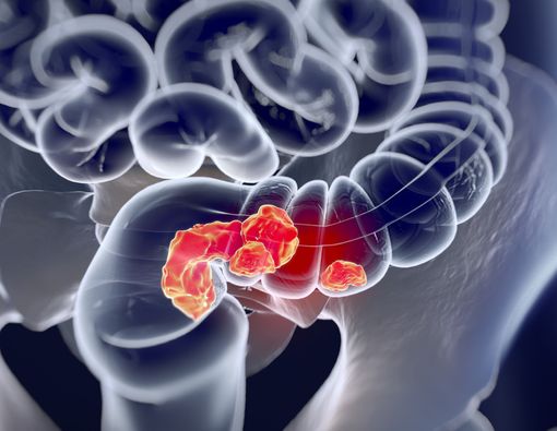 Kenali Komplikasi Kanker Usus