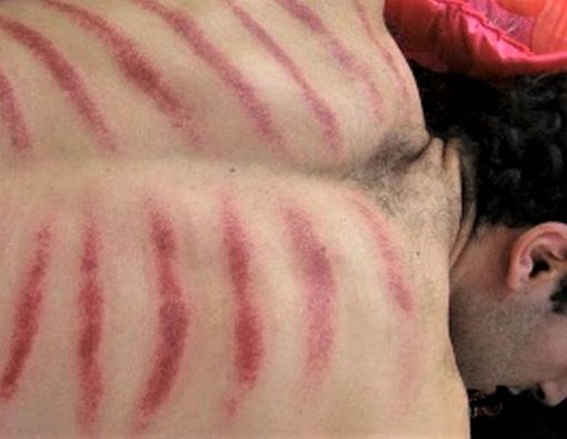 Kerokan Bisa Picu Stroke, Mitos atau Fakta?