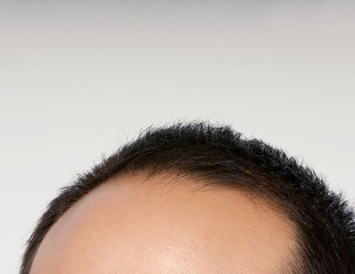 Cara Mengatasi Kebotakan Rambut