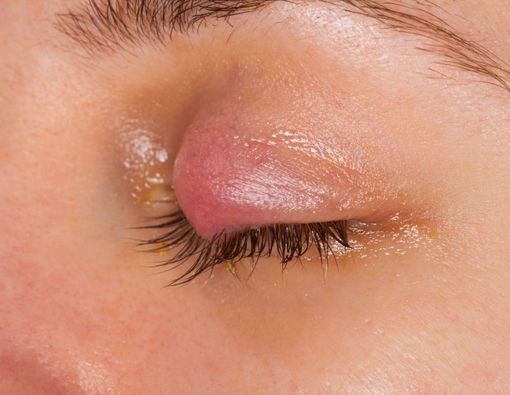 Kenali Gejala Kalazion pada Mata dan Komplikasinya