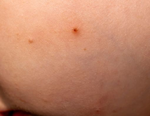 4 Infeksi Kulit yang Sering Terjadi pada Anak