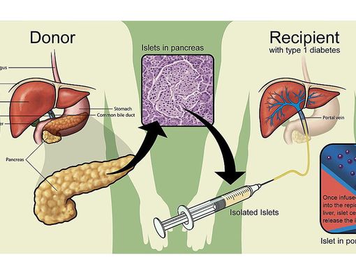 Risiko Transplantasi Islet pada Pengobatan Diabetes Tipe 1