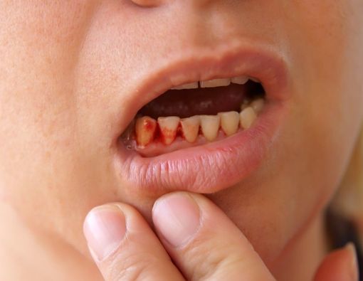 Coba Perhatikan, Penyebab Gusi Berdarah saat Hamil