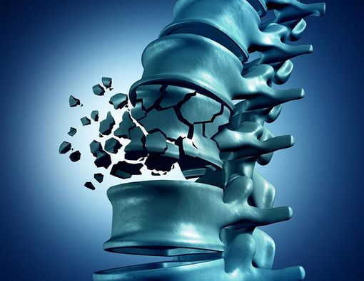 Inilah Dampak Buruk Osteoporosis bagi Tulang