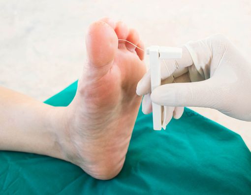 Anda Diabetes? Waspada Komplikasi Luka Kaki Diabetes