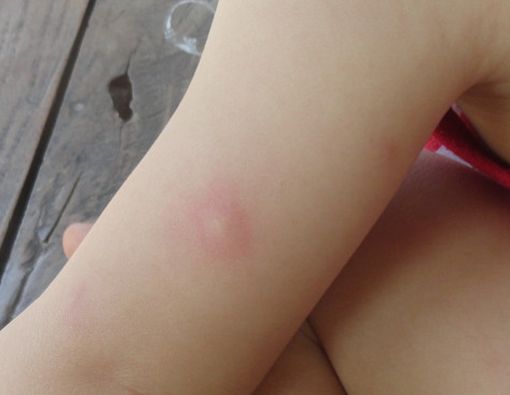 Anak Bisulan, Gara-gara Telur?