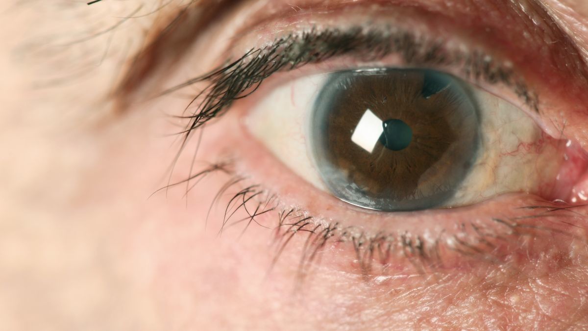 Cara Mencegah Kebutaan Akibat Glaukoma