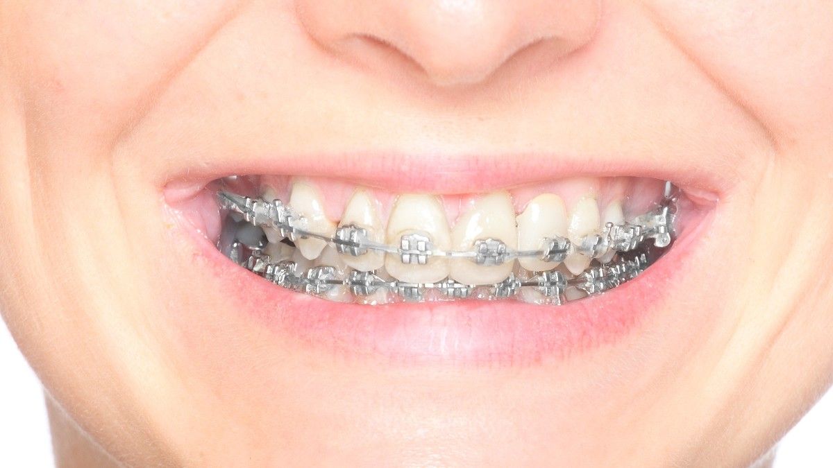 Mengenal Perawatan Orthodonti, Jenis dan Prosedurnya