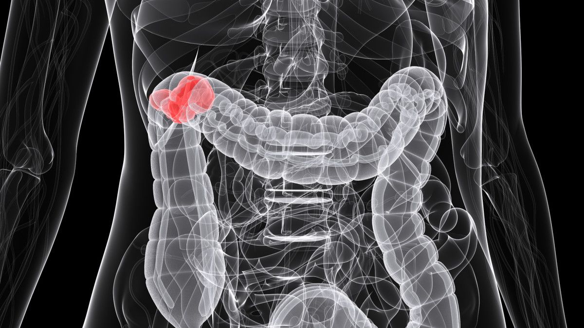 5 Gejala Kanker Usus yang Renggut Nyawa Eks KSAD George Toisutta