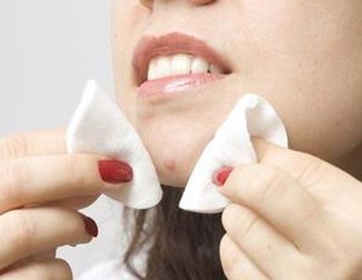 Pengobatan Jerawat & Bekasnya