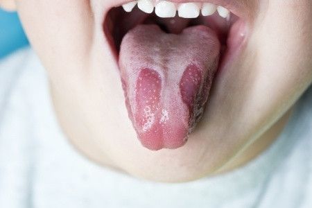 Beberapa Kelainan Lidah yang Biasa Terjadi