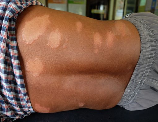 Lepra dan Kusta, Adakah Perbedaannya?