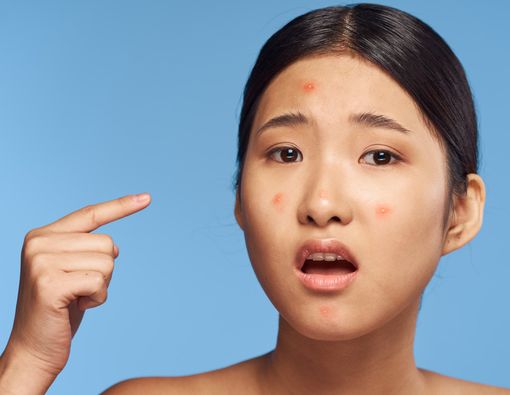 Solusi Atasi Jerawat Berdasarkan Letaknya di Wajah Anda!