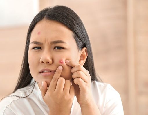 17 Cara Menghilangkan Jerawat Secara Alami Tanpa Obat