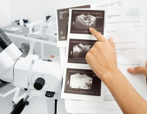 5 Cara Mendiagnosis Kista Ovarium