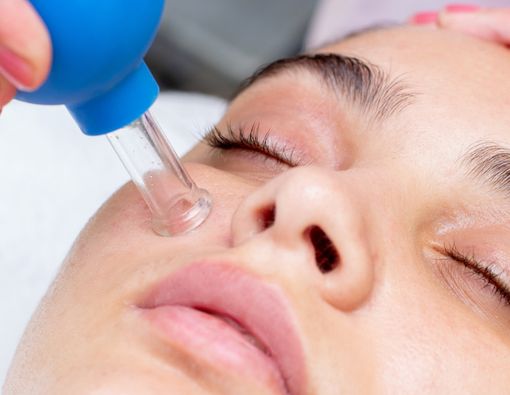 Menyingkap Manfaat Bekam untuk Jerawat