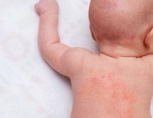 Berbagai Masalah Kulit yang Sering Dialami Bayi